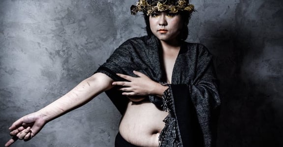 【胖女體攝影集】肥好：蟹足腫、肥胖紋、自殘傷痕，都是我的年輪