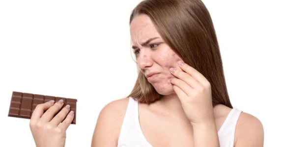 「吃巧克力長痘痘」是謠言還是事實？讓皮膚科醫師告訴你