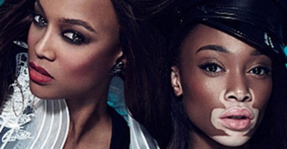 「我的故事，就畫在我身上」白斑症女模 Chantelle，美該由自己定義